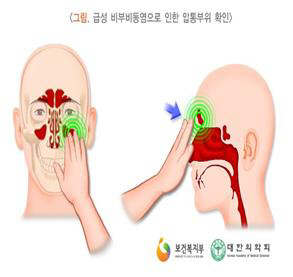 축농증