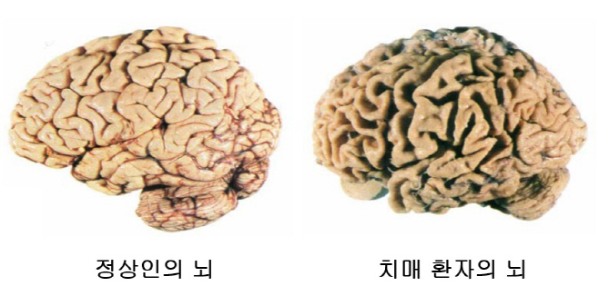 [사진2]치매 환자의 뇌 사진
