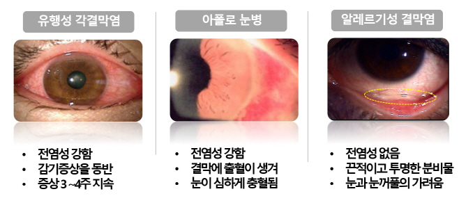 사진3_유행성각결막염,아폴로눈병,알레르기성결막염