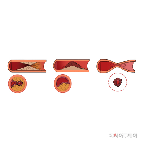 [그림3] 동맥경화가 진행된 혈관의 단면