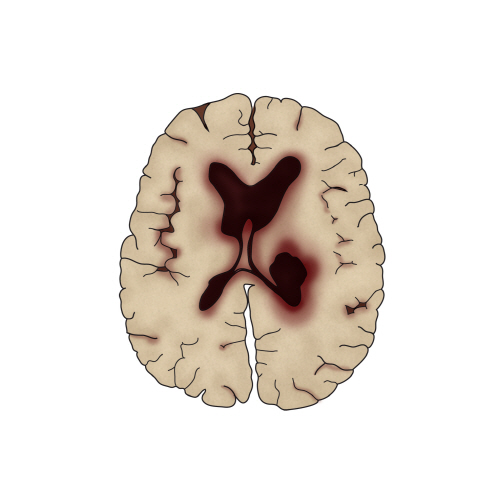 [그림2] 뇌출혈