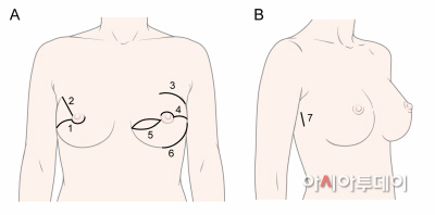 유방암 수술 절개흔 그림