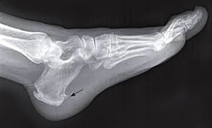 족저근막염 부위