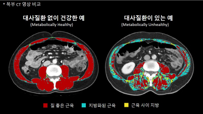 복부 CT 영상 비교
