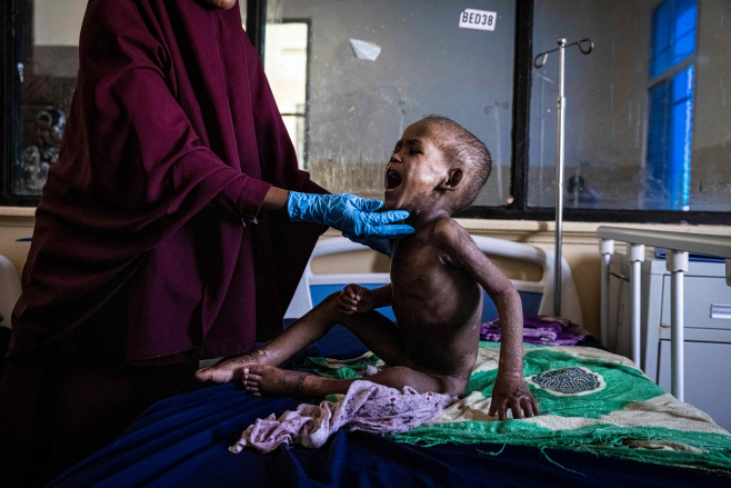 SOMALIA-DROUGHT-HOSPITAL <YONHAP NO-6639> (AFP)