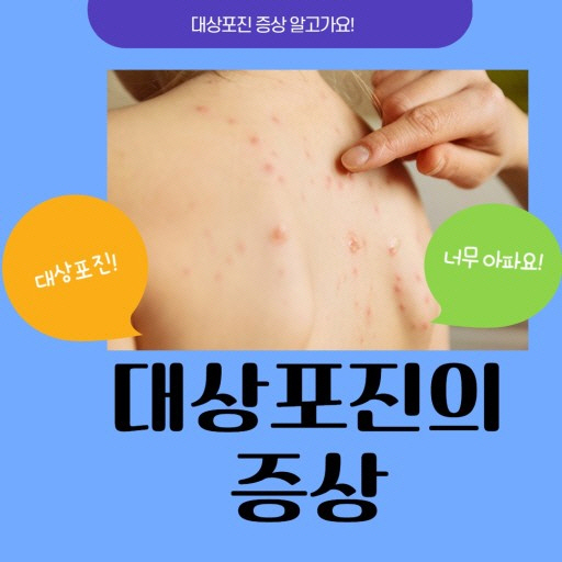대상포진