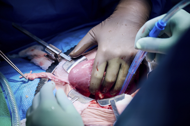 Pig Kidney Transplant <YONHAP NO-4939> (AP)