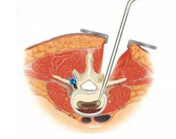 최소침습 척추경 체재 케이지 삽입술