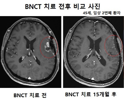 첨부_BNCT 치료 전후 사진