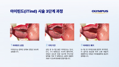 [사진자료 2] 아이틴드 시술 3단계 과정