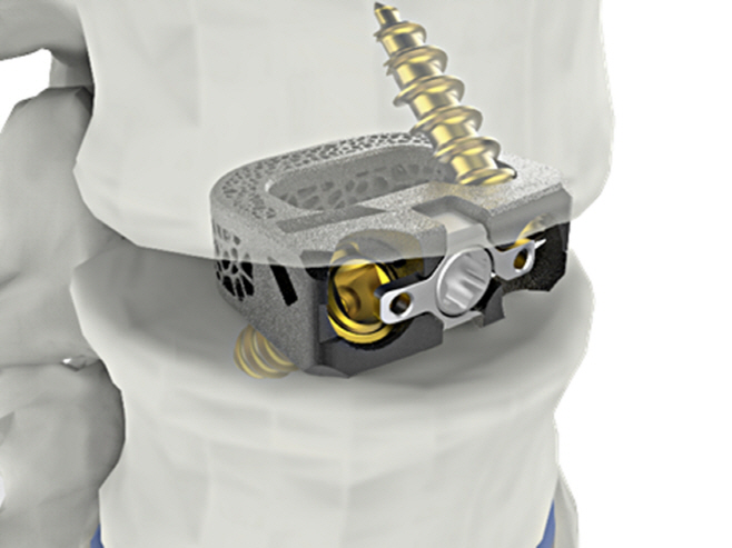 [사진자료] 척추 융합기기 ‘유니스페이스(UniSpace® TPLIF Cage, 요추 케이지)’ 美 FDA 승인 획득