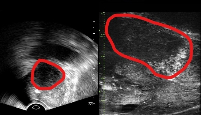 존 전립선 초음파 사진(좌) 및 마이크로 초음파 사진(우).