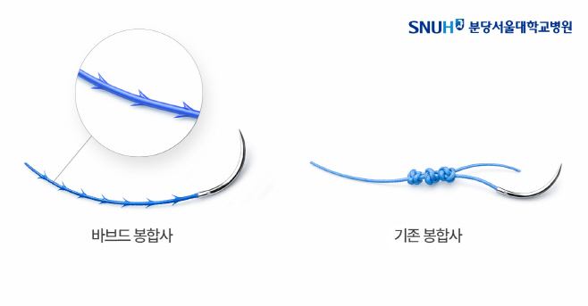 [그림] 바브드 봉합사(좌)와 기존 봉합사(우) 비교